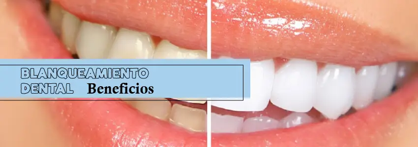 Beneficios del blanqueamiento dental